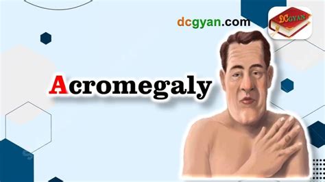 understanding acromegaly causes symptoms and treatment options happy life