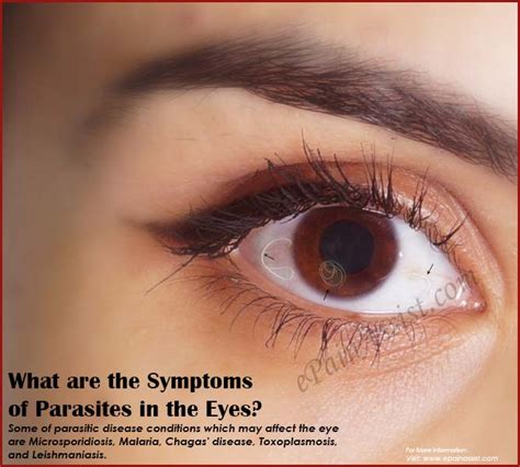 Symptoms Of Parasites In Eyes