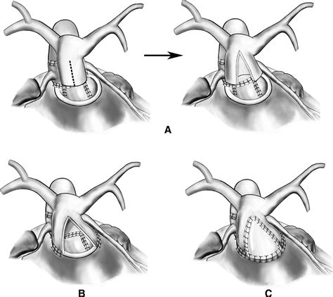 Technique Of Aortic Translocation For The Management Of Transposition