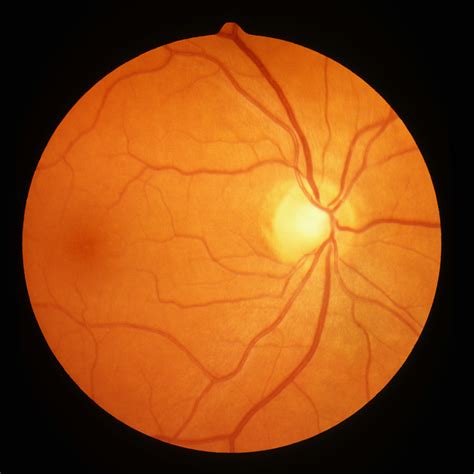 Optic Disc Crescent Size Location Influences Myopia Optometry Advisor