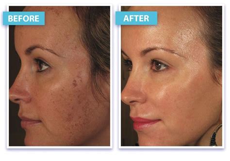 Kleresca Skin Rejuvenation Before And After