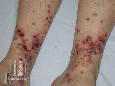 Skin Rash On Legs