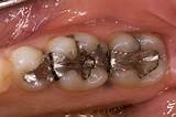 Images of Dental Silver Fillings