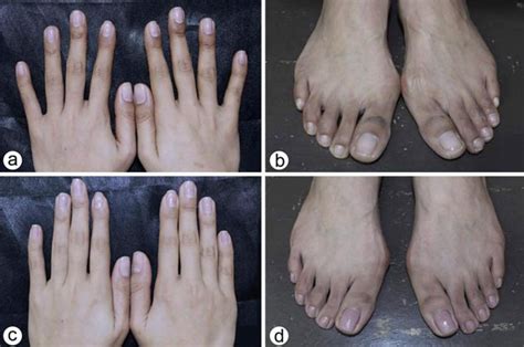 Hyperpigmentation Of Both Hands And Feet Initially The Patient Showed