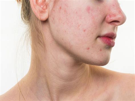 9 Home Remedies To Get Rid Of Heat Boils On Face Styles At Life