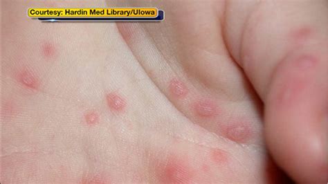 Hand Foot And Mouth Disease Outbreak At Princeton University 6abc