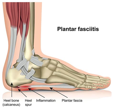 Plantar Fasciitis Dr7 Physiotherapy Podiatry Hydrotherapy Massage
