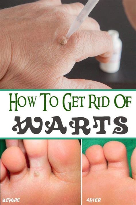 How To Get Rid Of Warts Flawlessshape Get Rid Of Warts How To Get