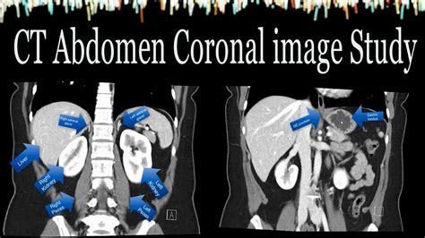 Ct Scan Of Abdomen Coronal Image Study Youtube