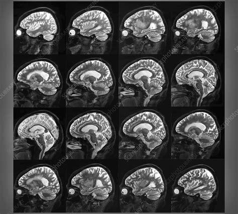 Alzheimer S Disease Mri Brain Scans Stock Image C