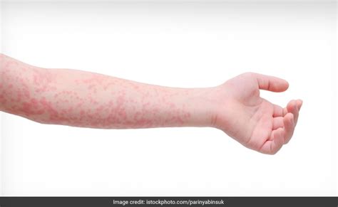 Red Dots On The Skin Causes And Remedies