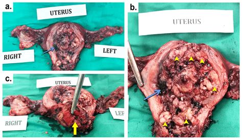Gross Appearance And Cut Surface Of The Uterus With Endometrial Cancer
