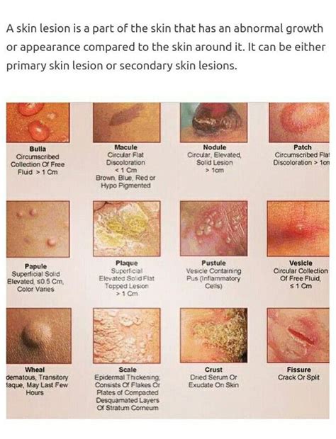 Types Of Skin Lesions Top 10 Most Aggressive Types Of Cancer Skin