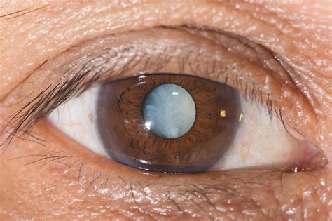 These Eye Drops Can Treat Cataract Without A Surgery