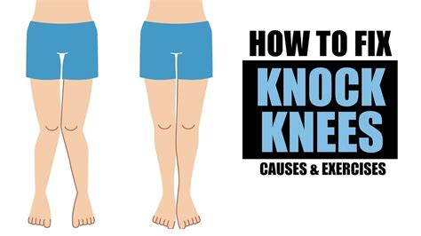 Can You Correct Knock Knees With Exercise Exercisewalls