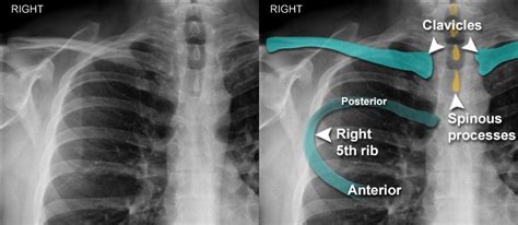 Chest X Ray Anatomy Bones