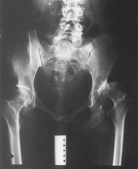 Case 5 34 Years Old A Preoperative Radiograph Of The Pelvis