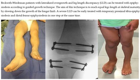 Children Free Full Text Guided Growth In Leg Length Discrepancy In