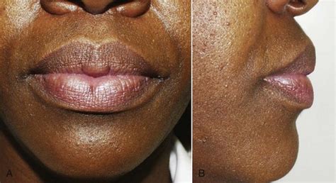 What Causes Protruding Lower Lip