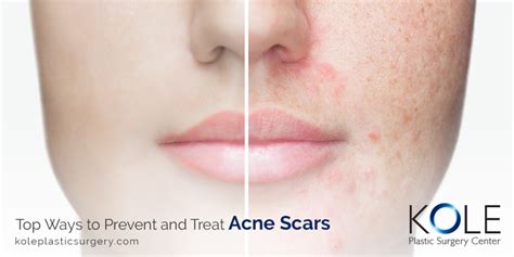 Top Ways To Prevent And Treat Acne Scars