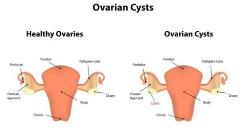 Ovarian Cyst Rupture Symptoms And Causes