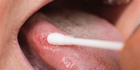 Dry Mouthxerostomia Impact And Symptoms Surbiton Dental