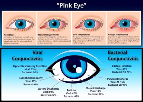 Conjunctivitis Or Pink Eye Is An Inflammation Of The Conjunctiva The Clear Mucous Membrane