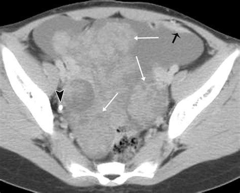 Borderline Papillary Serous Tumor Of The Right Ovary Radiographics