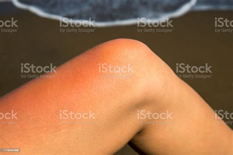Woman Leg With Red Sunburn Skin On Seaside Background Sunburned Skin