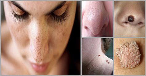 Eliminate Moles Warts Blackheads Skin Tags And Age Spots Completely