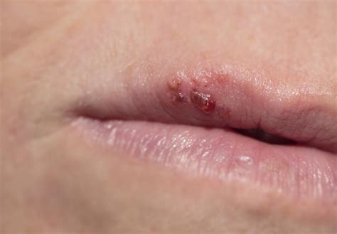 Bump On Lip Causes Treatment And When To See A Doctor