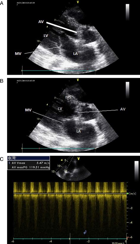 A And B Tte Plax Showing Prosthetic Aortic Valve In Systole And