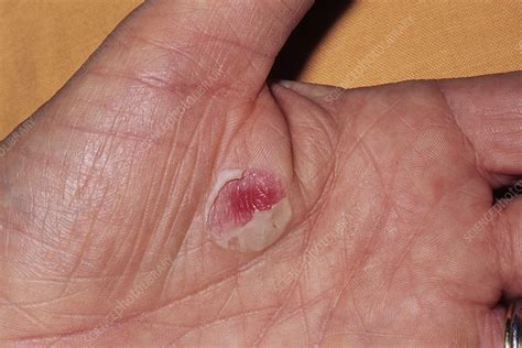 Burn Blister Day 5 Stock Image M3350186 Science Photo Library