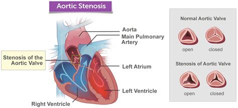 Aortic Stenosis Causes Symptoms Diagnosis Treatment And Surgery