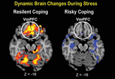 Brain Finding May Help Identify People Most Likely To Stress Out