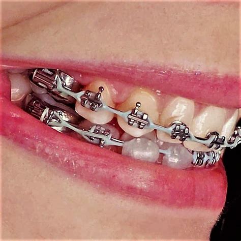 Pin By John Beeson On Orthodontic Braces Charm Bracelet Pandora