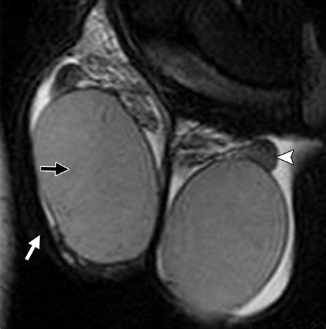 Mr Imaging Of The Penis And Scrotum Radiographics
