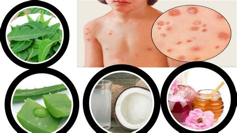 Home Remedies For Chickenpox Top 20 Home Remedies For Chickenpox Youtube