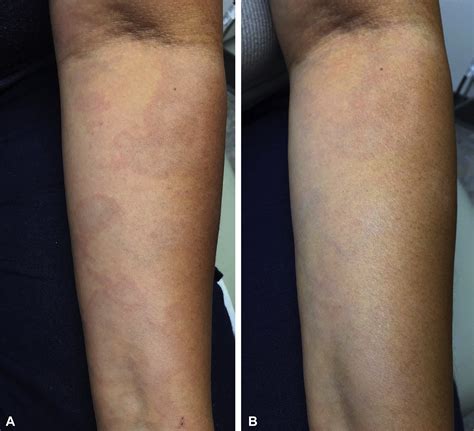 Combination Therapy With Prednisone And Isotretinoin In Early Erythema