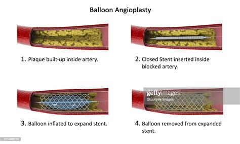 Diagram Showing Procedure Of Balloon Angioplasty High Res Vector