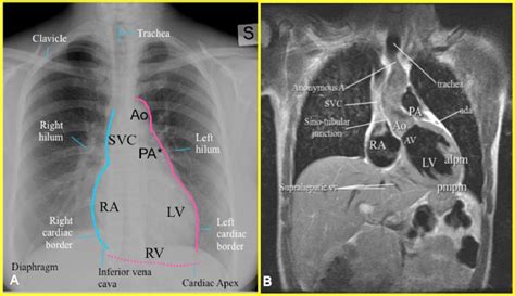 Chest X Ray Cardiac Anatomy And Pathology Correlation With