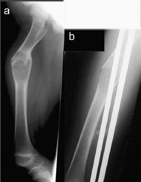 Fibrous Dysplasia Femur Download Scientific Diagram