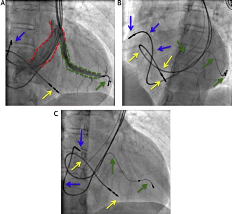 Cardiac Resynchronization Therapy In A Chagasic Patient With Persistent