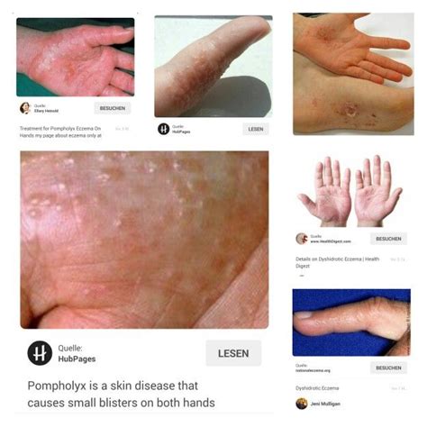 Dyshidrosis Eczema Health Beauty