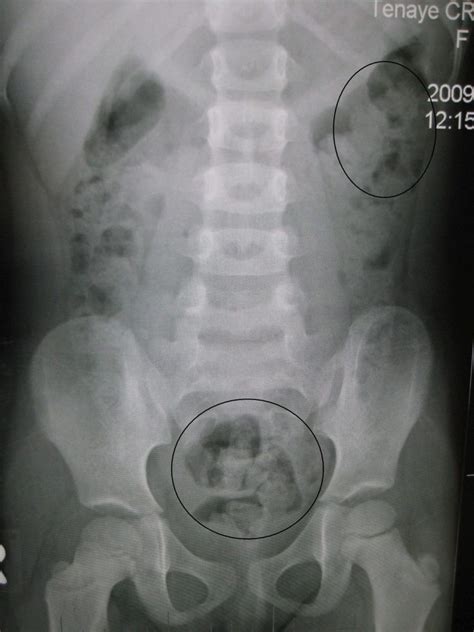 Radiografía De Abdomen 8 Signos Clave Que Debes Saber Constipation