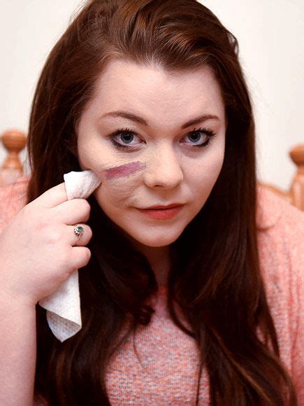 Woman Who Camouflaged Large Facial Birthmark For Over A Decade Decides