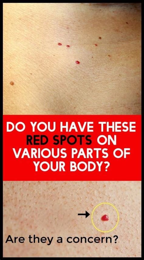 What Does Red Spots On Skin Mean Frequently Asked Questions