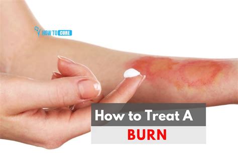 Best Ways To Treat Burns With Honey And Essential Oils Health Nigeria