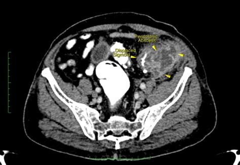 Pixel Acute Sigmoid Diverticulitis With Pericolonic Abscess