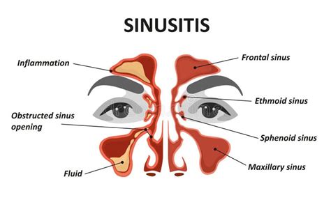 Human Sinusitis Inflammation Illustration Vector Art Stock Vector